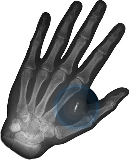 sholar essay on rfid chips implanted|Biohacking and Chip Implantation in the Human Hand: An .